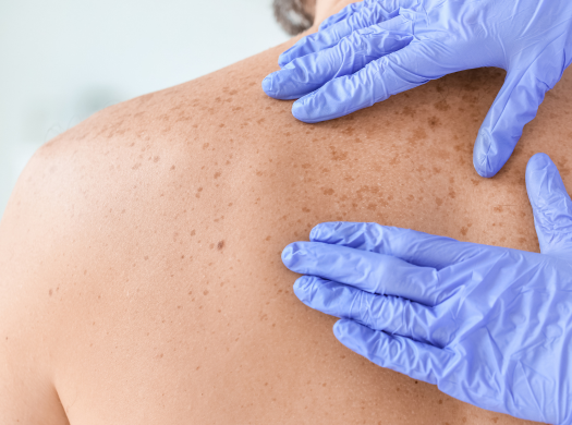 Hautarzt-Herold-Vlanti-Hautkrebssreening