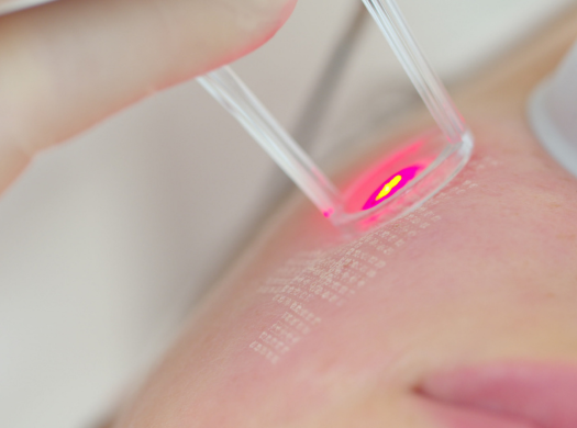 Hautarzt-Herold-Vlanti-Lasertherapie